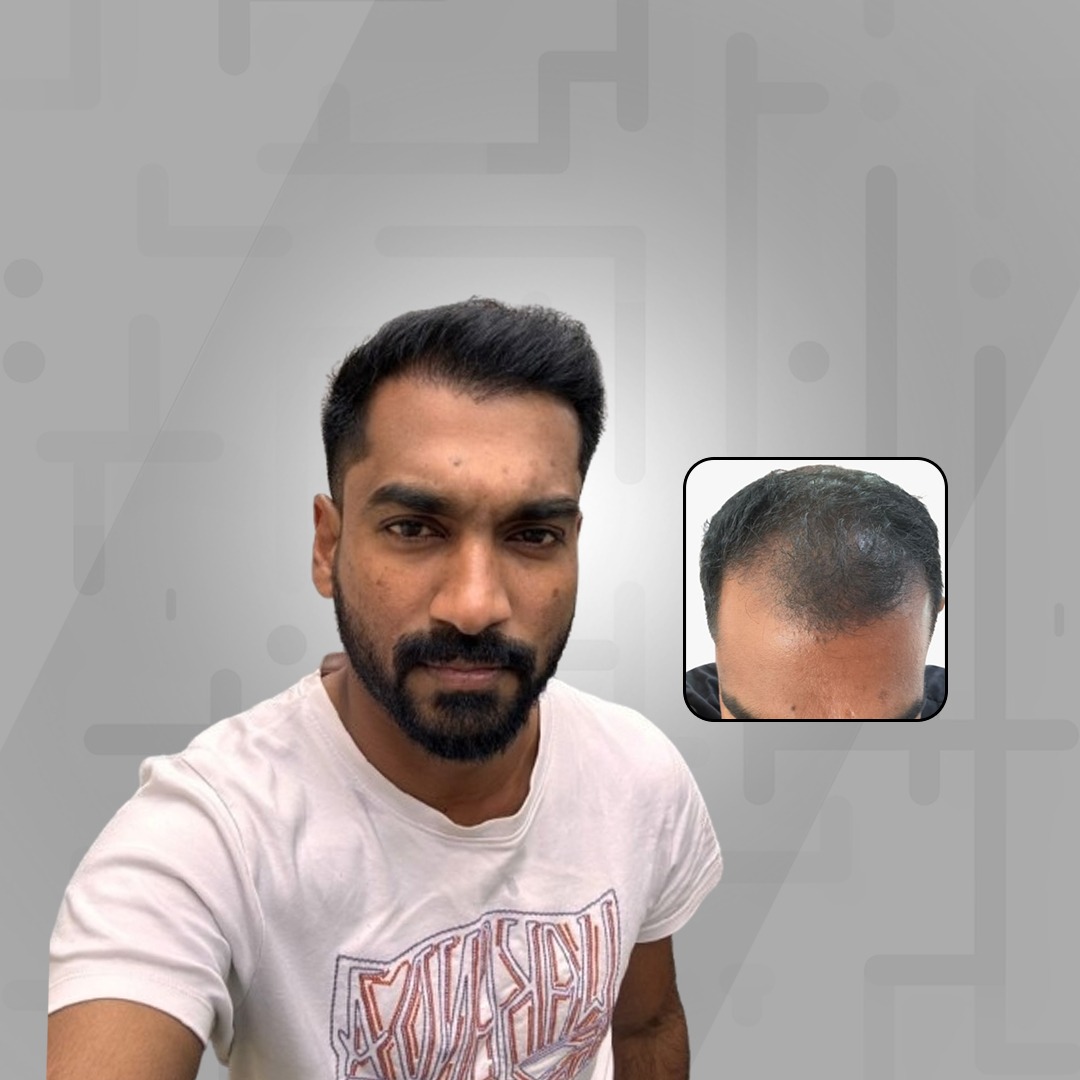 Doctor applying medicine to women's hair - Best hair loss treatments in Kochi, Kerala - Hair Wellness Clinic