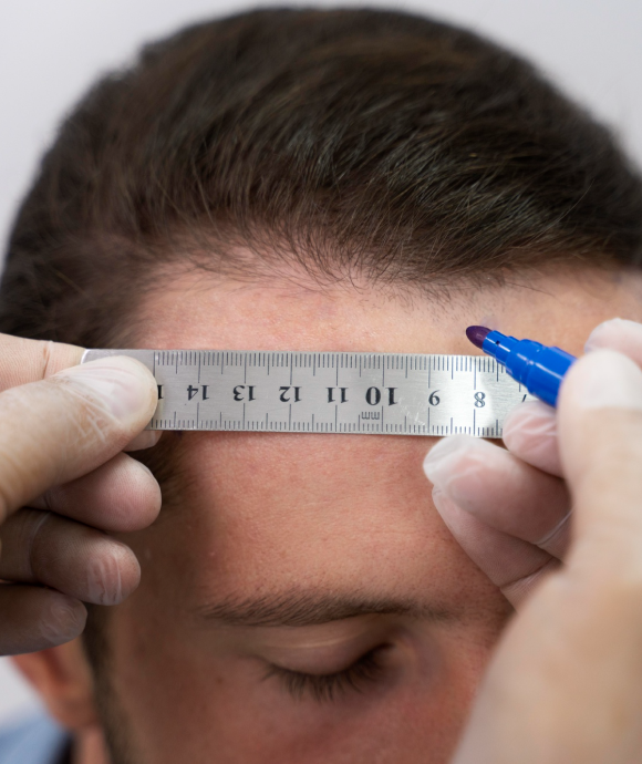 Hair transplant procedure in Kochi, Kerala - Hair Wellness Clinic