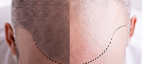 Best hair replacement in Kochi, Kerala - Hair Wellness Clinic