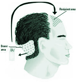 Follicular Unit Extraction FUE in Kochi, Kerala - Hair Wellness Clinic