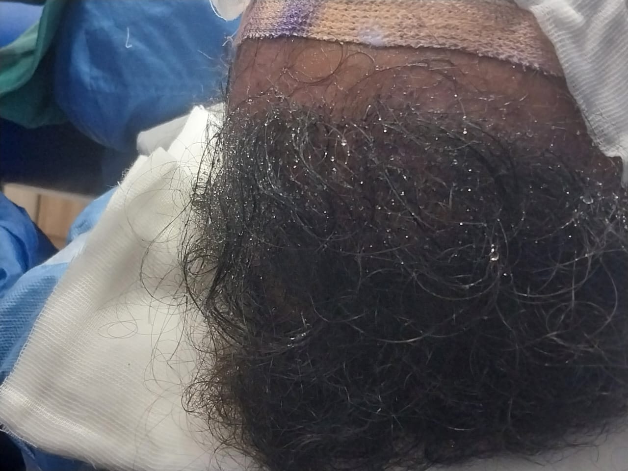 Hair transplant procedure for hairfall and baldness - Hair Wellness Clinic