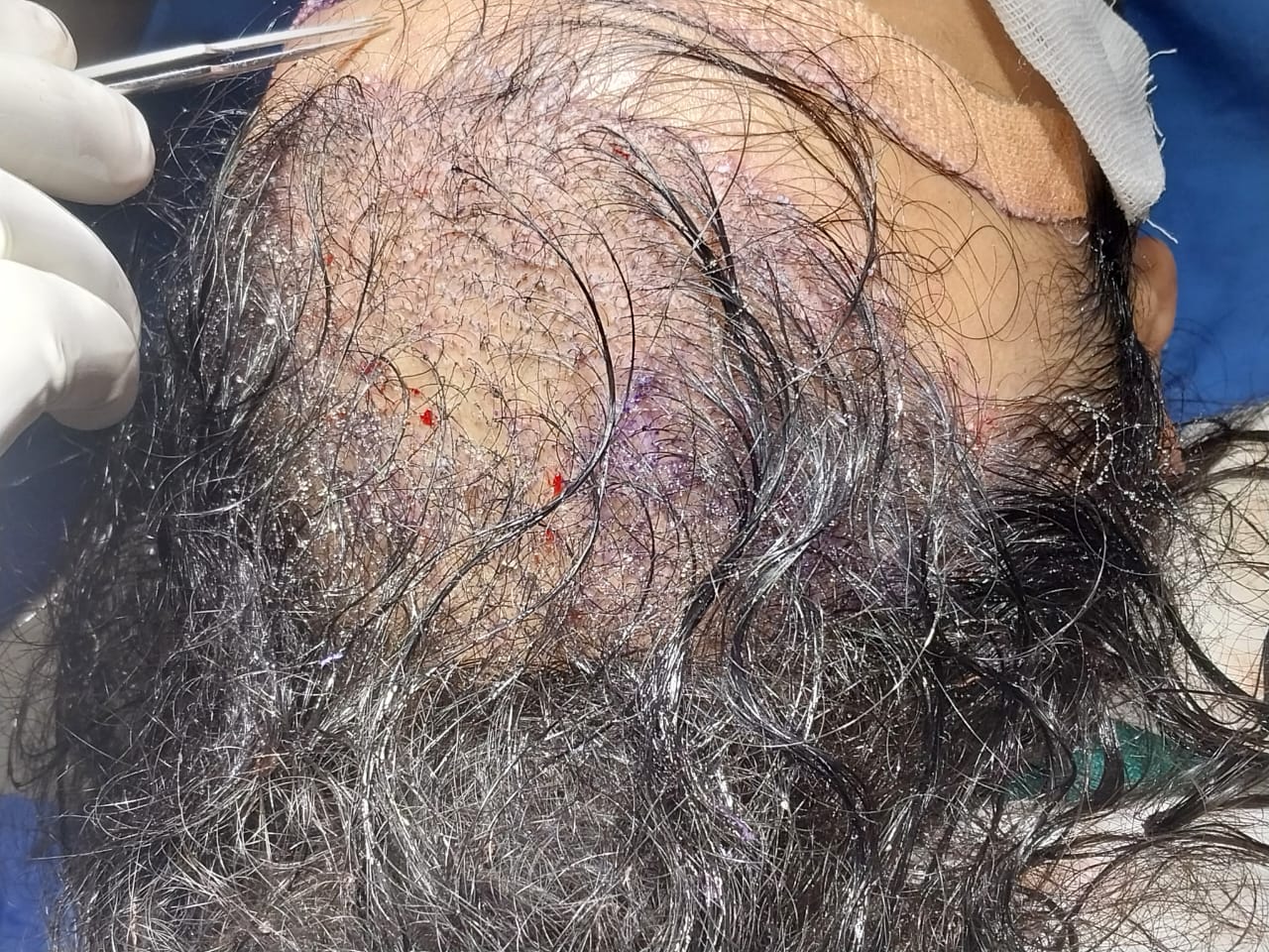 Follicuar unit extraction procedure for hair loss - Hair Wellness Clinic