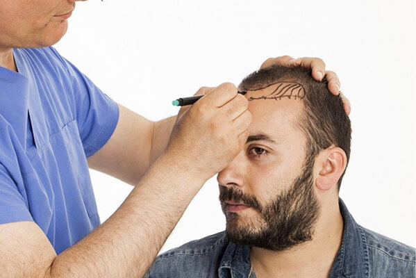  best Surgical hair transplantation FUE in kerala kochi calicut Hair Wellness Clinic