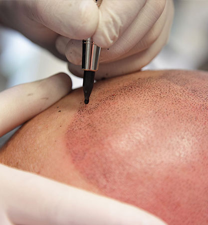 Best clinic for hair replacement in Kochi, Kerala - Hair Wellness Clinic