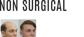 Best clinic for hair replacement in Kochi, Kerala - Hair Wellness Clinic