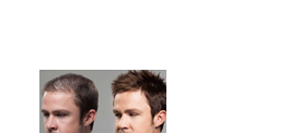 Best hair restoration clinic in Kerala - Hair Wellness Clinic