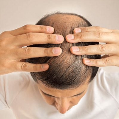 HWC integrated hair restoration in Kochi, Kerala - Hair Wellness Clinic