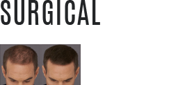 Best hair transplant in Kerala - Hair Wellness Clinic